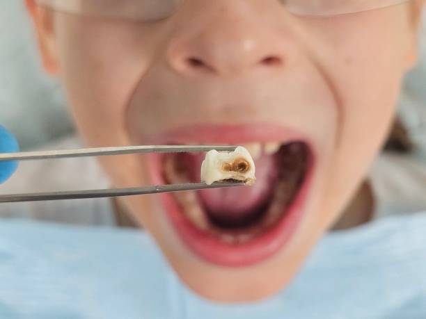 Best Emergency Treatment for Dental Infections or Abscesses in Manchester, KY